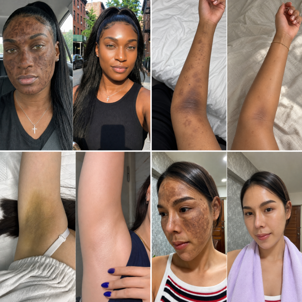 Four before and after pairs: two faces, an underarm and a forearm cleared of hyperpigmentation