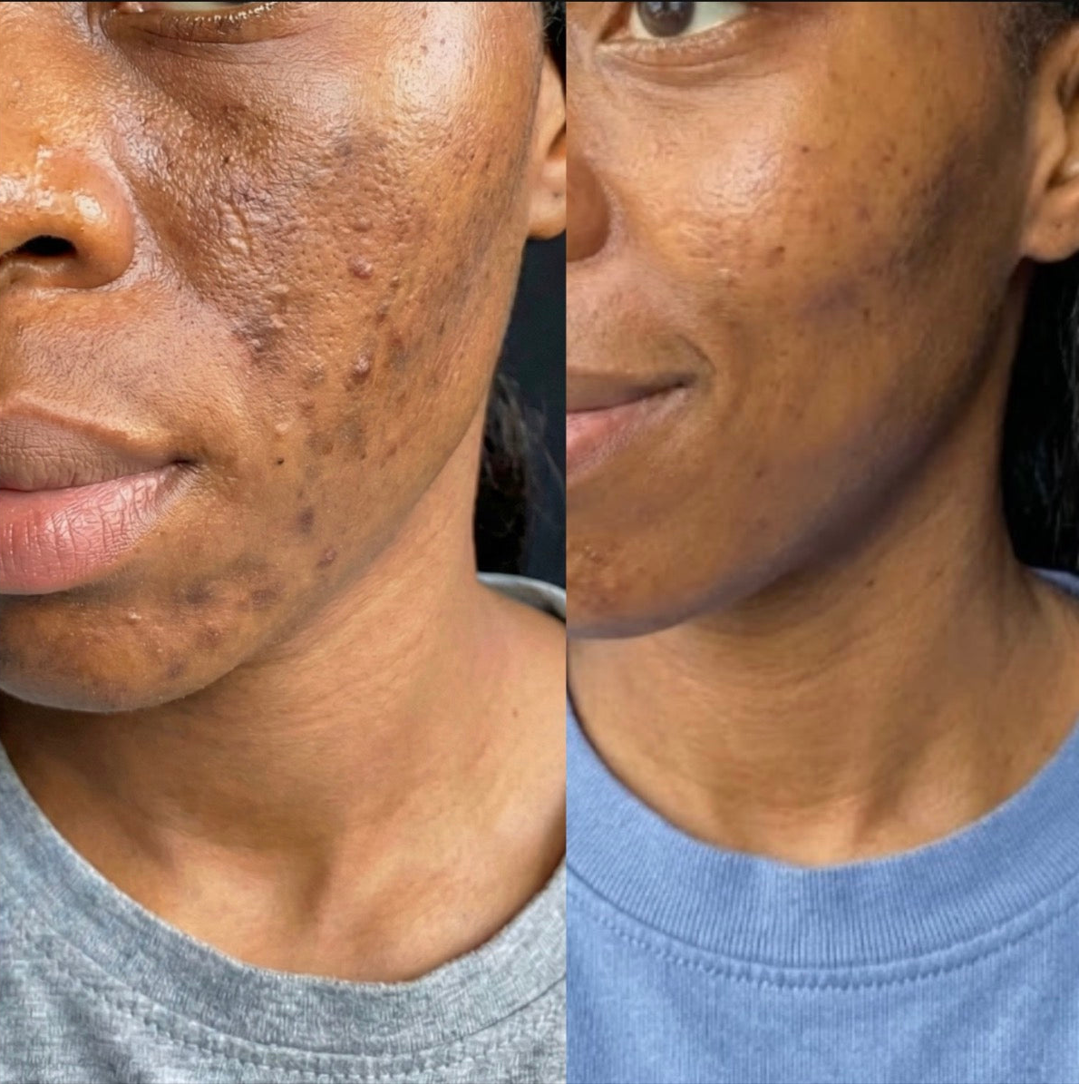 Dark marks across the cheek and jaw untreated, beside the same face clearer after 10 uses