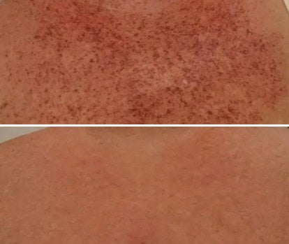 Dense dark spots across the chest untreated, above the same chest clear after 10 uses
