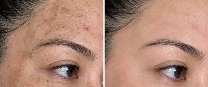 Dark patches across the forehead and temple, then the same skin visibly faded after 30 days