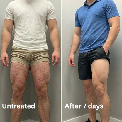 Advanced Triple-Acid Complex for Keratosis Pilaris (Copy)