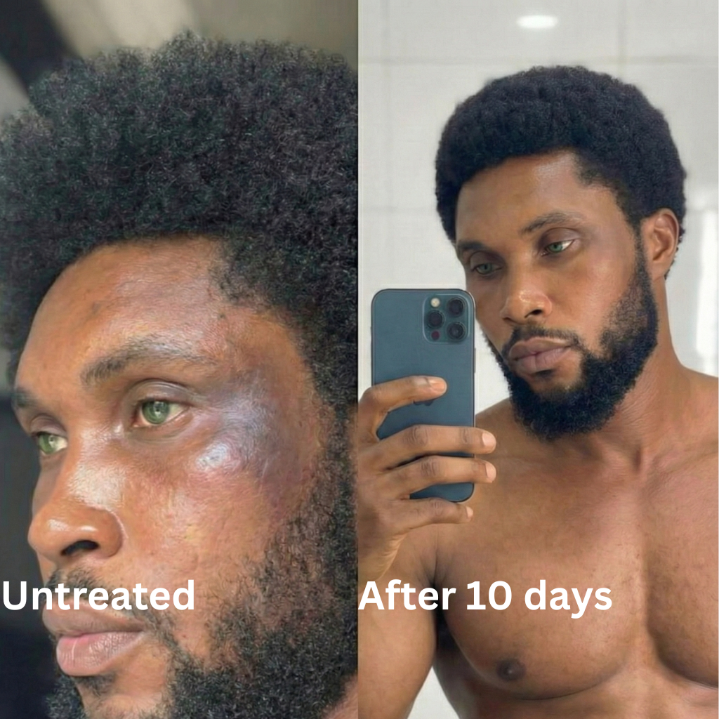 Advanced Triple-Acid Complex for Hyperpigmentation (Copy)