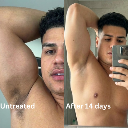 Advanced Triple-Acid Complex for Hyperpigmentation (Copy)