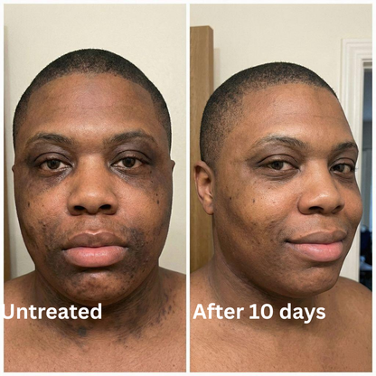 Advanced Triple-Acid Complex for Hyperpigmentation (Copy)