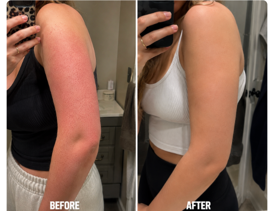Before and after: Lauren's arm, redness and dark spots fading after three weeks