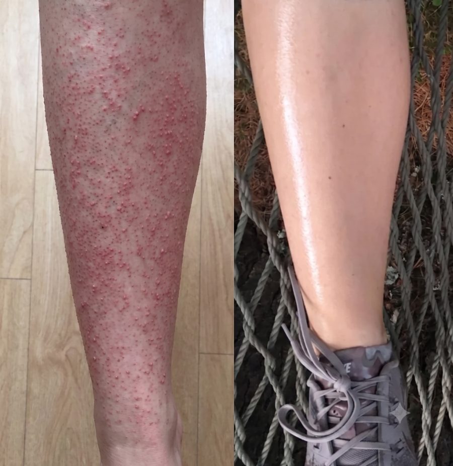 Lower leg, untreated vs. after three uses