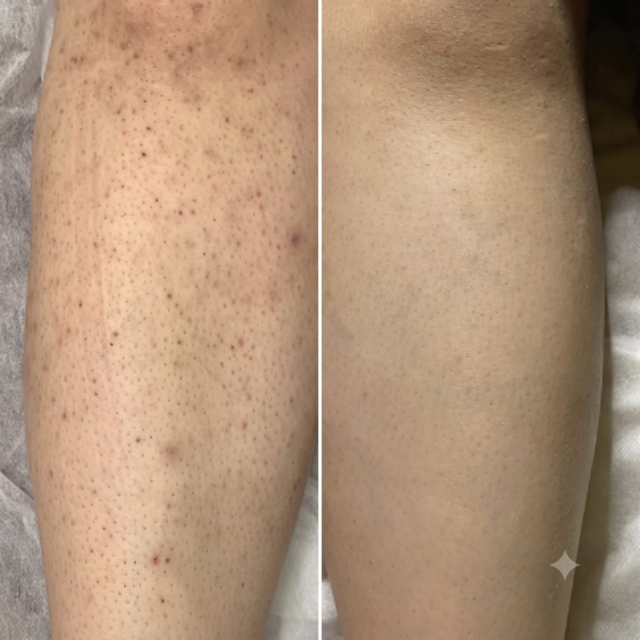 Untreated vs. after 2 uses