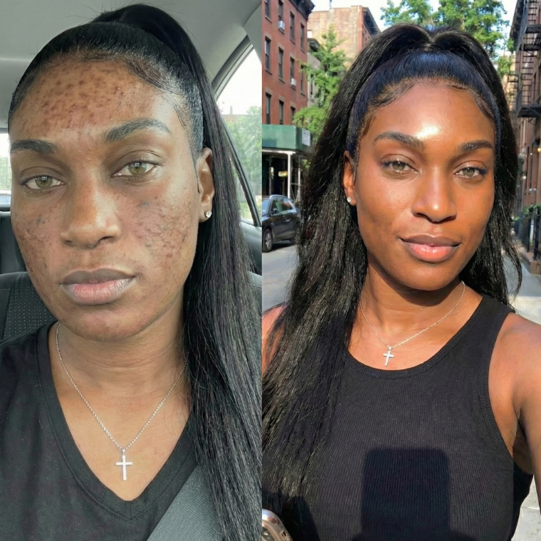 Before and after: a face marked with dark spots, clear and glowing after two weeks