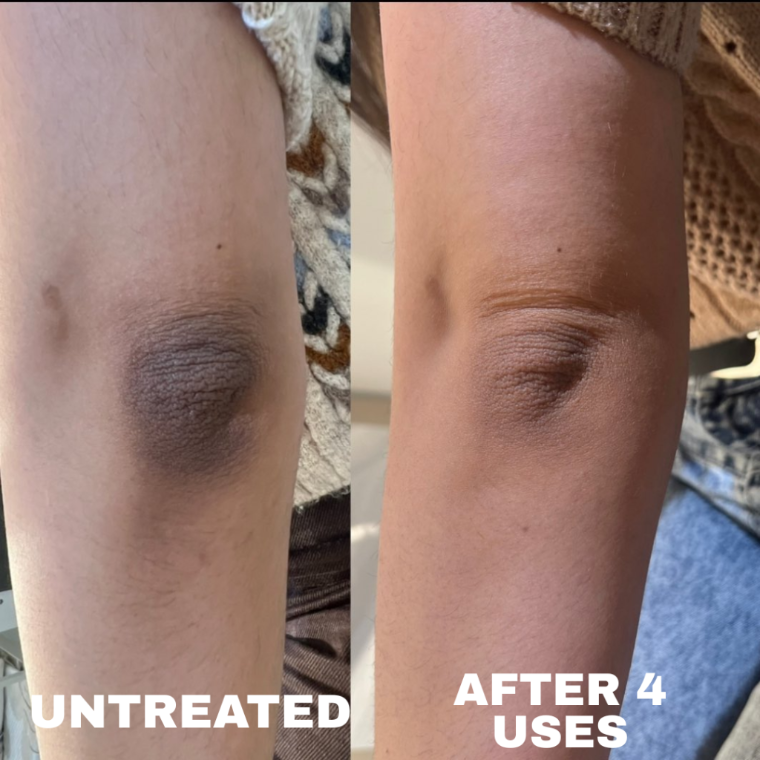 Before and after: Tiana's elbow, dark pigmentation visibly lighter after six weeks