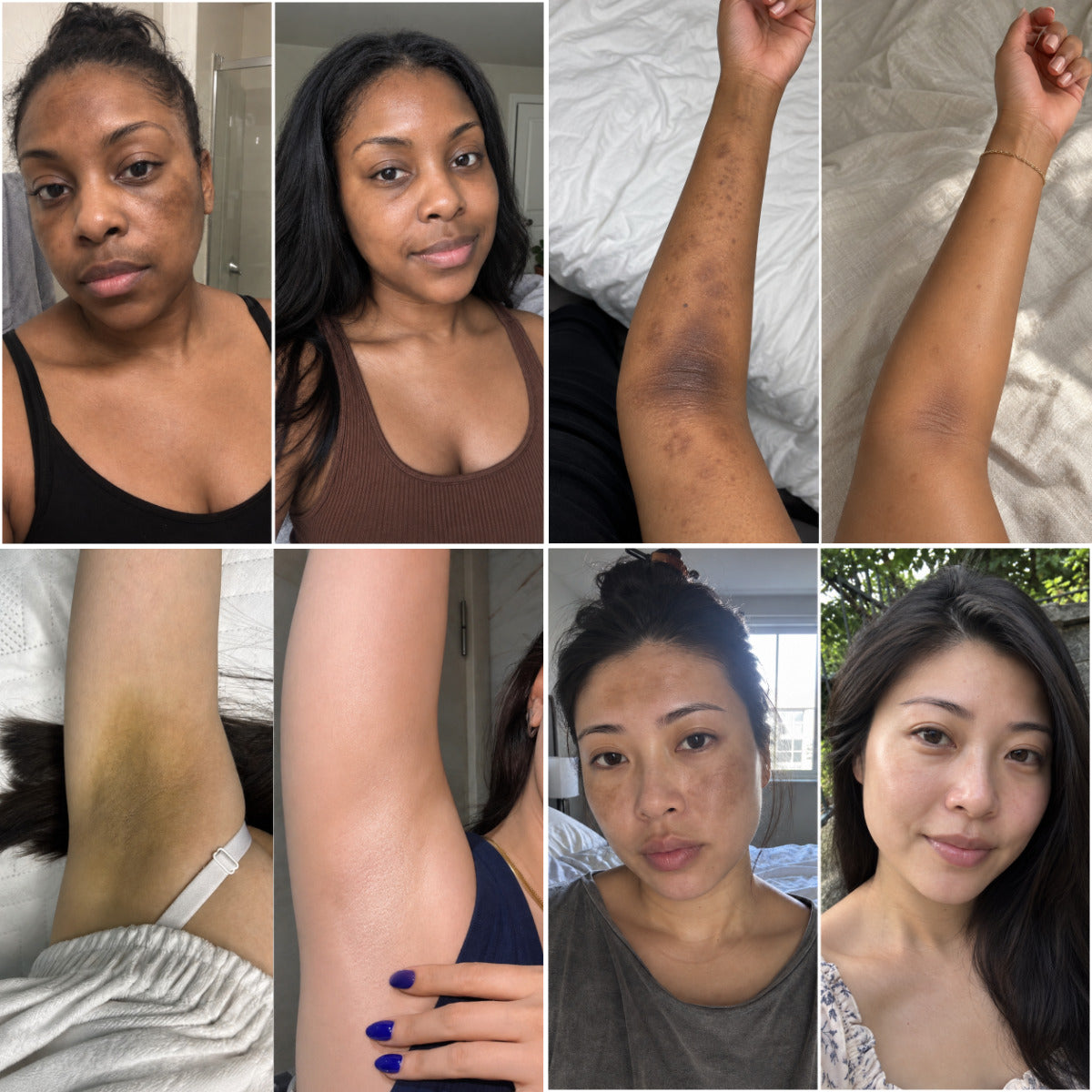 Four before and after pairs: two faces, an underarm and a forearm cleared of hyperpigmentation