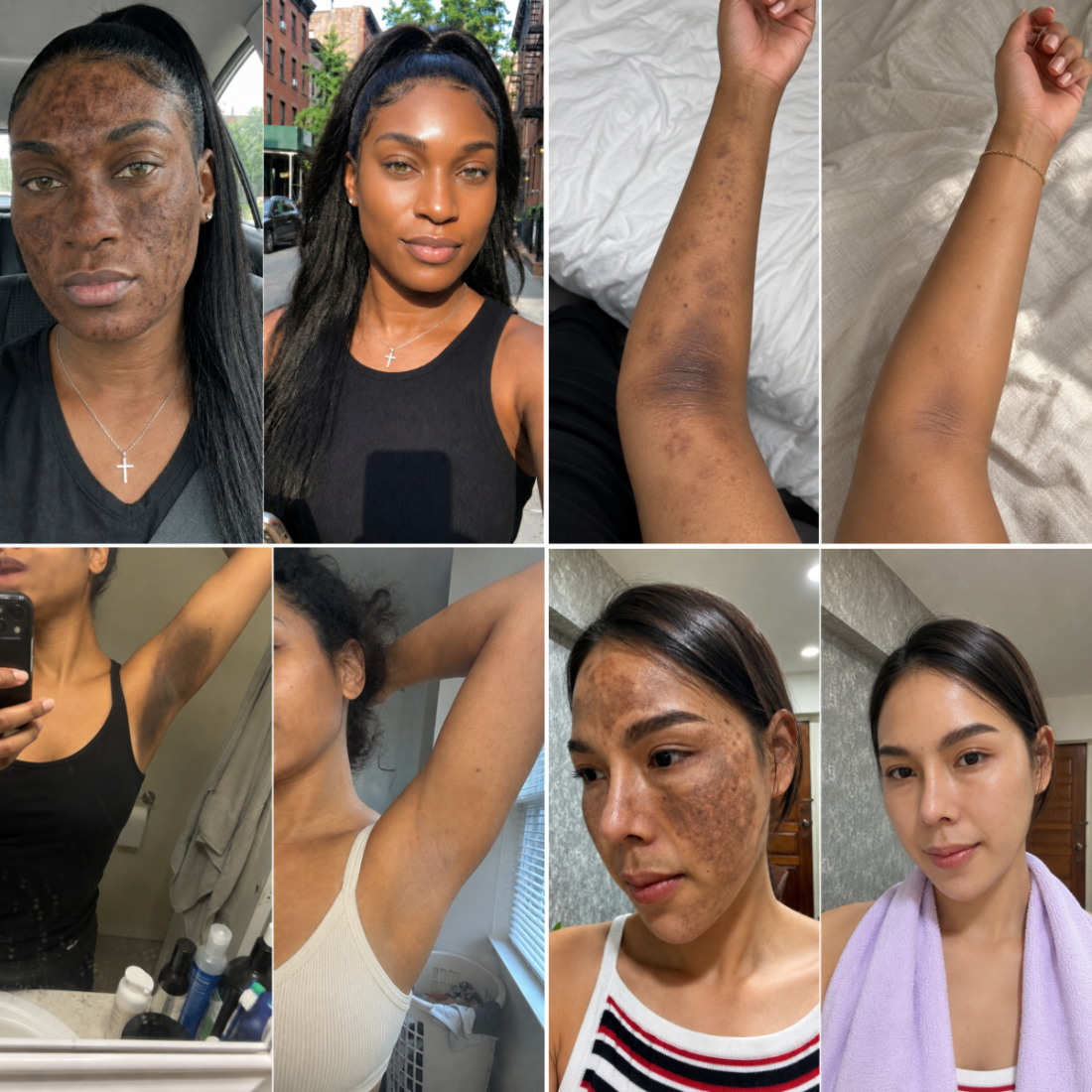 Four before and after pairs: two faces, an underarm and a forearm cleared of hyperpigmentation
