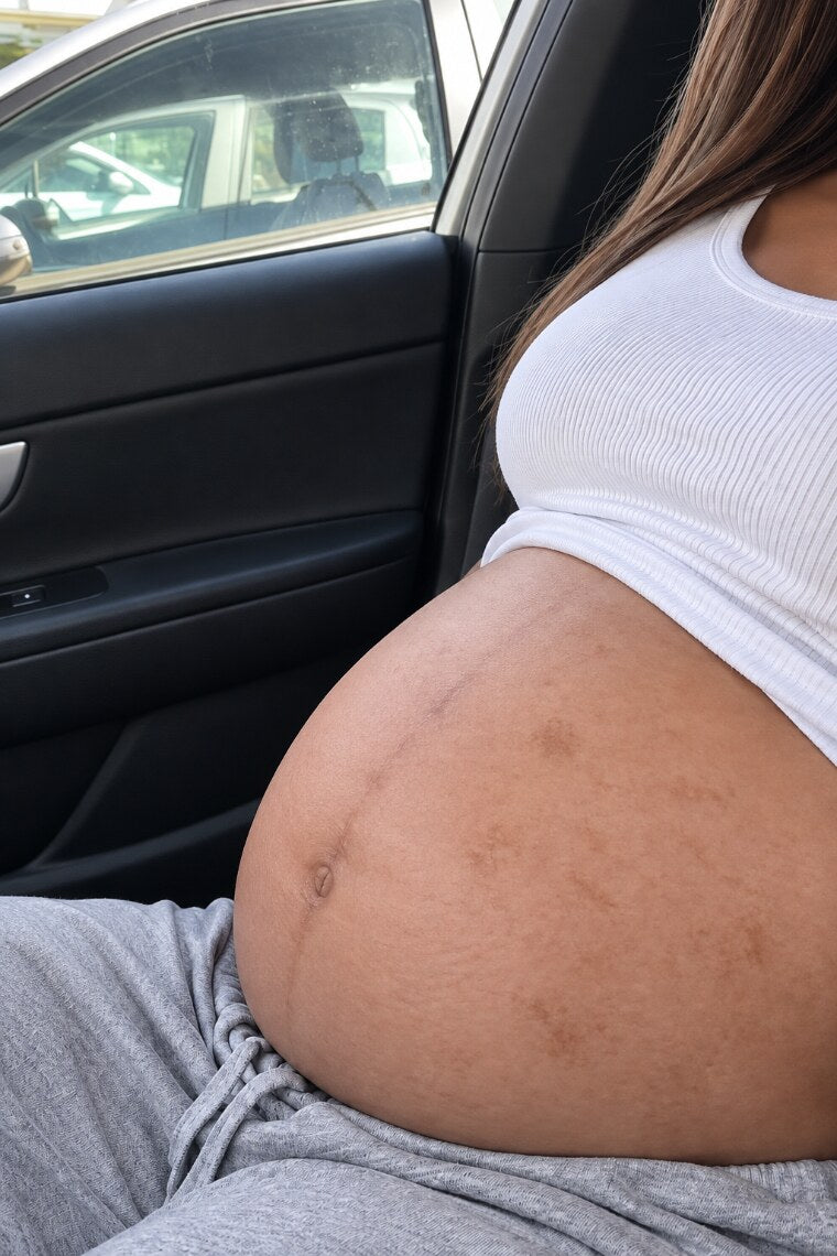 A pregnant belly with darkened skin along the midline