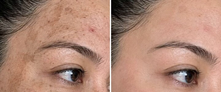 Dark patches across the forehead and temple, then the same skin visibly faded after 30 days