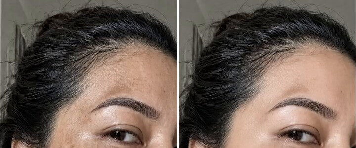 Uneven brown patches on the forehead, then the same forehead even-toned after 30 days