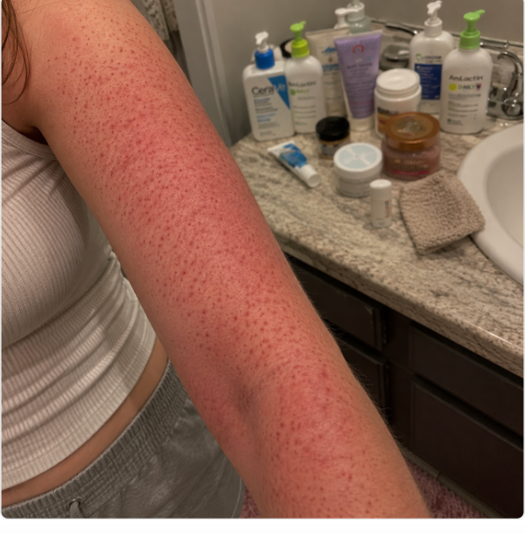 Red, bumpy KP on an arm beside a counter full of products that didn't work