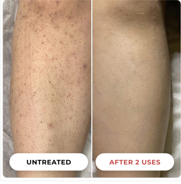 Before and after: a leg with red, bumpy KP beside the same leg noticeably smoother after two uses
