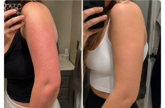 Before and after: Lauren's arm, redness and dark spots fading after three weeks