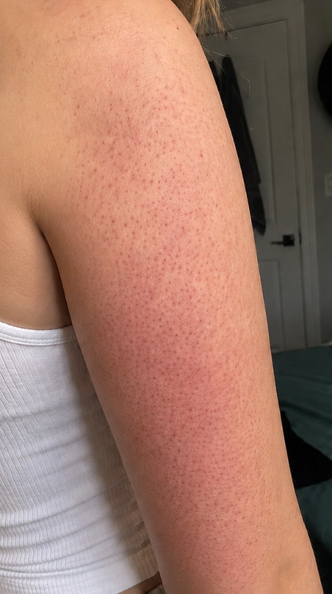 Samantha's arm before