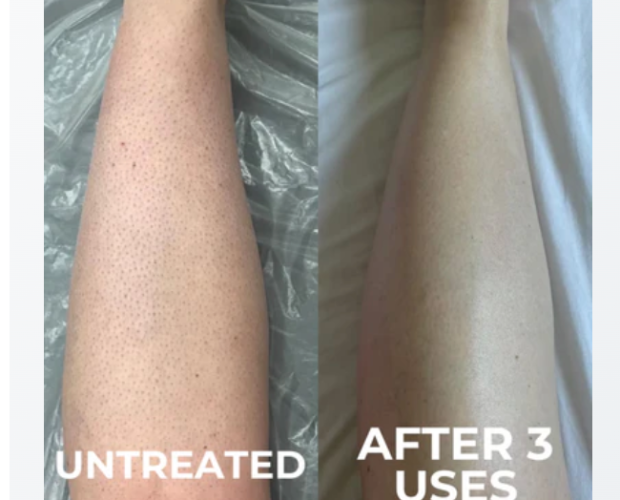 Sarah's leg untreated and after 3 uses