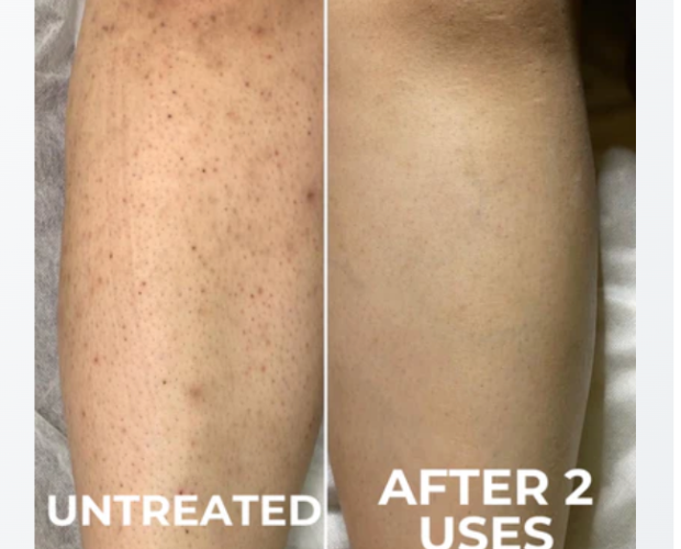 Rebecca's leg untreated and after 2 uses