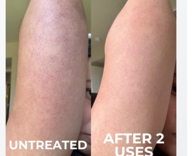 Jessica's arm untreated and after 2 uses