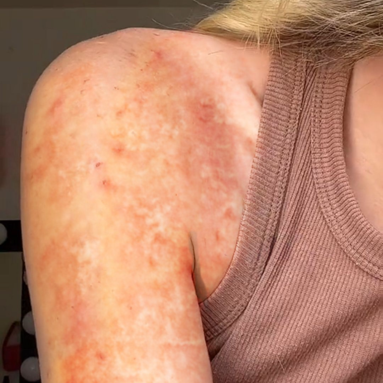 An active eczema flare across a shoulder and upper arm, red and inflamed