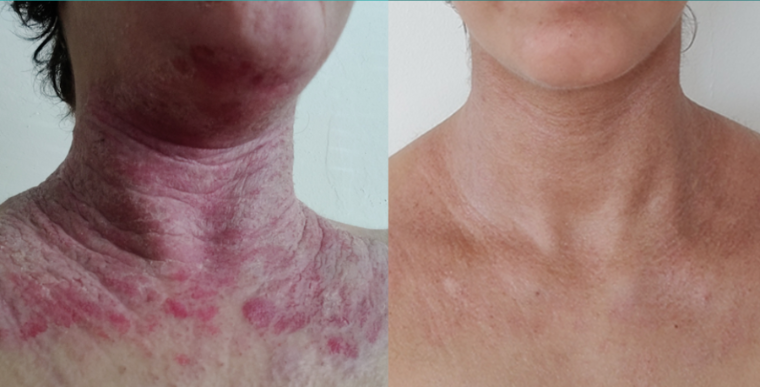 Before and after: a woman's neck and chest raw with eczema, calm and even after treatment