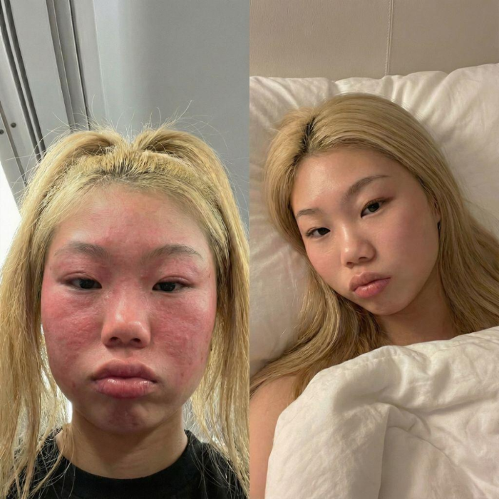 Cheeks raw and inflamed with eczema beside the same skin calm and clear