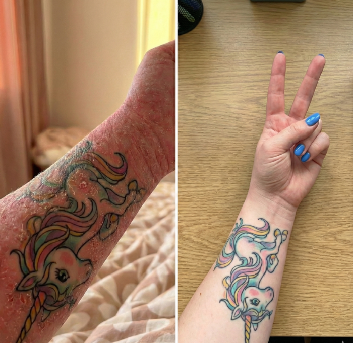 A forearm and wrist cracked and raw with eczema beside the same skin completely smooth