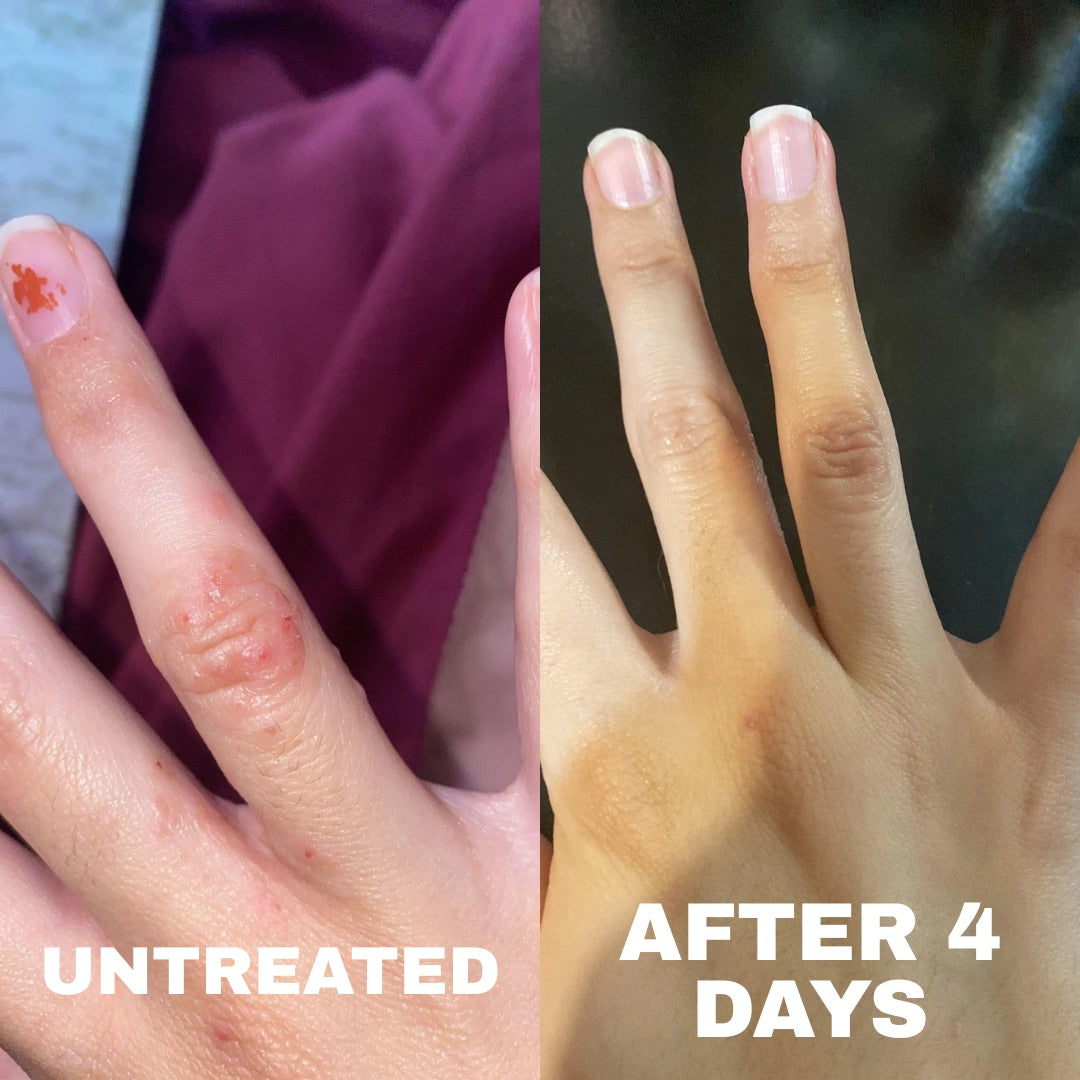 Eczema hand before and after