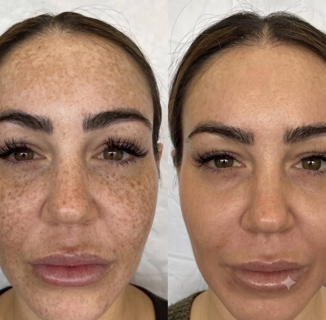 Before and after