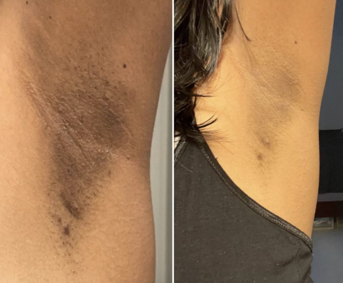 Before and after — underarm
