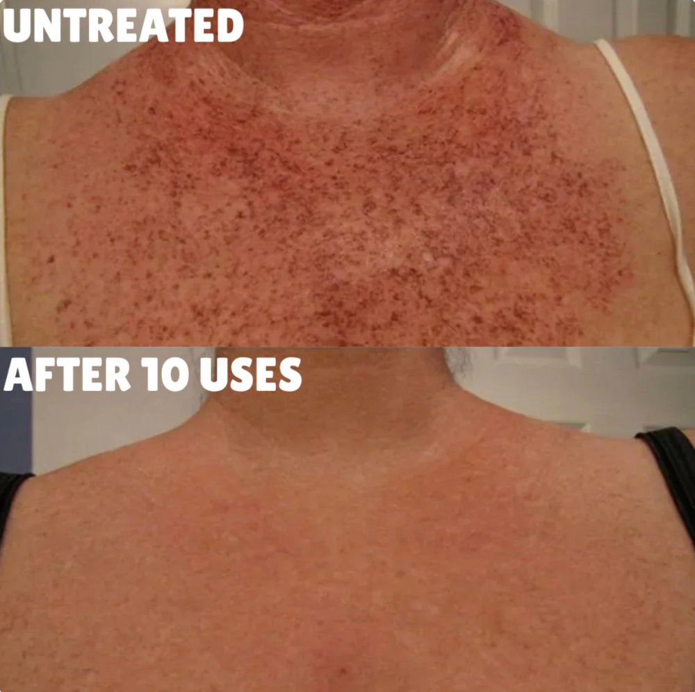 Before and after — chest