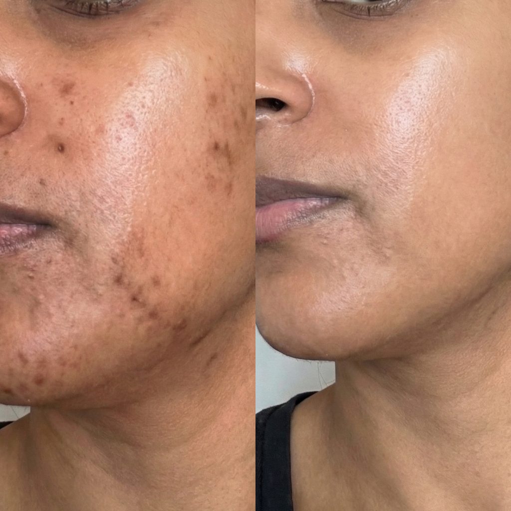 Before and after — face