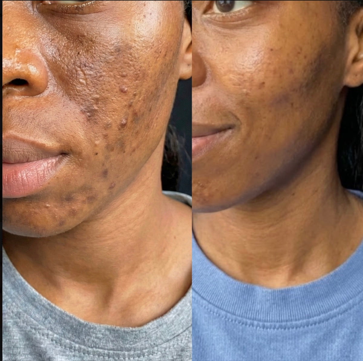Before and after: dark spots faded on the face