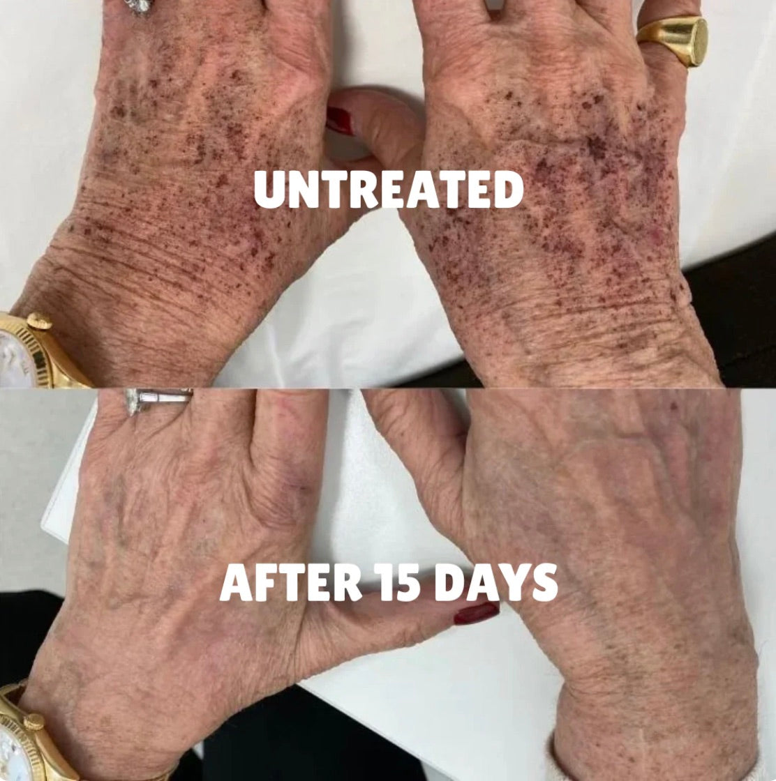 Before and after: sun spots on hands faded