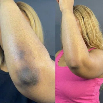 Before and after: elbow brightening