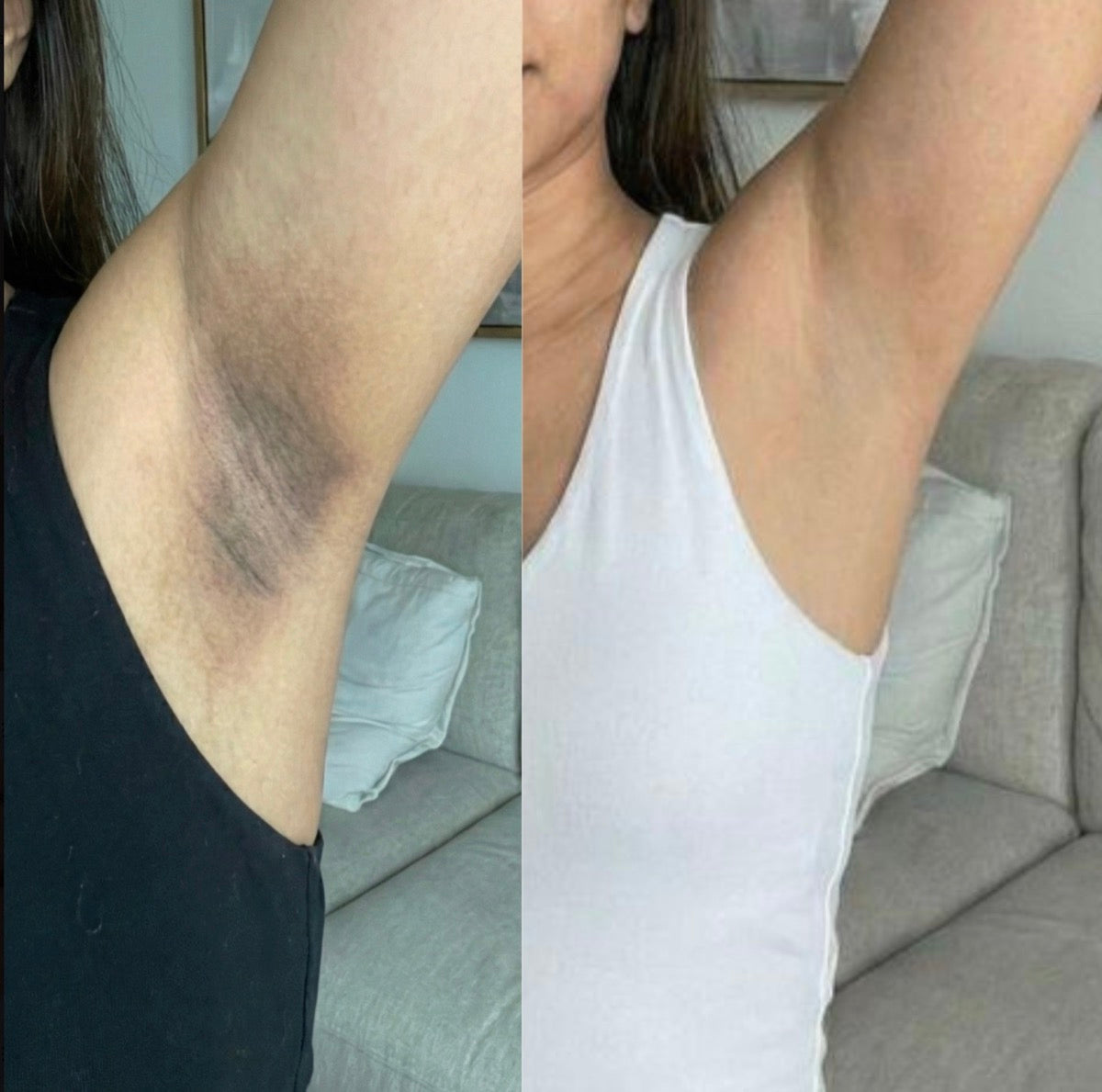 Before and after: underarm pigmentation faded and smoothed