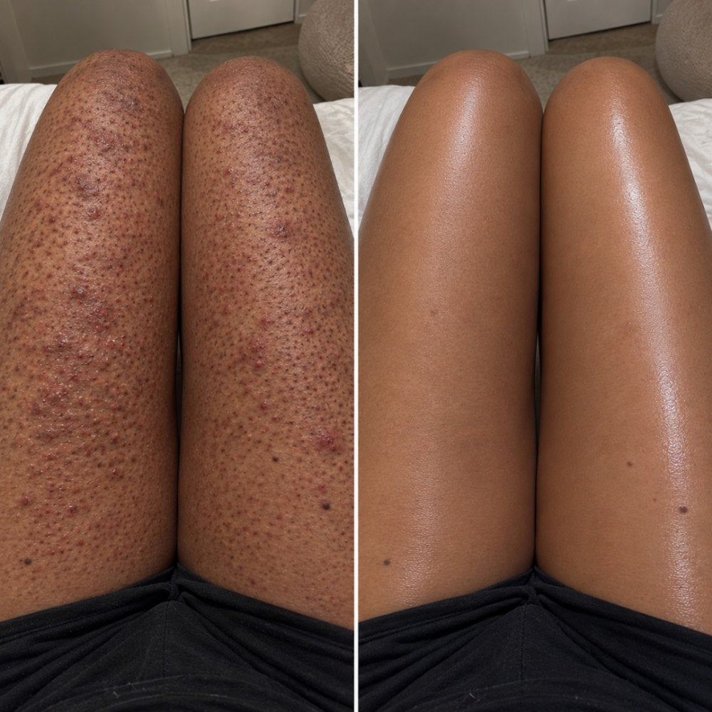 Thighs before and after