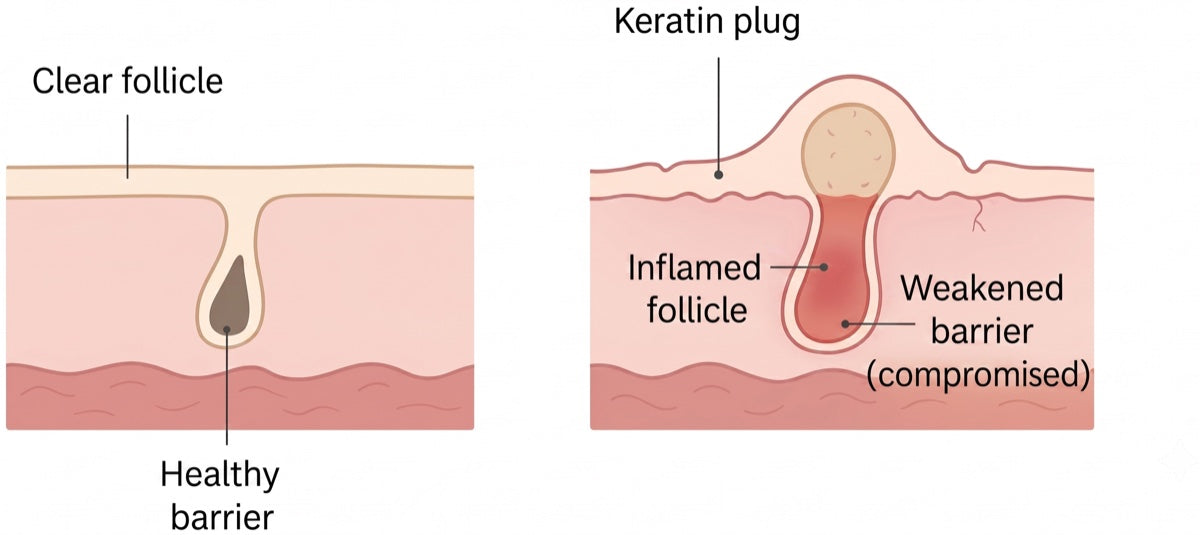Cross-section: normal skin with clear follicle and healthy barrier versus keratosis pilaris skin with keratin plug, inflamed follicle and weakened barrier