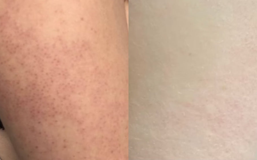 Untreated vs. after 7 days