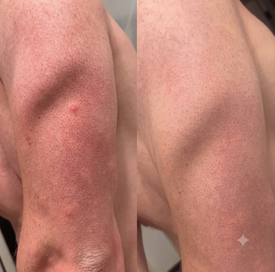 Untreated vs. after 4 days