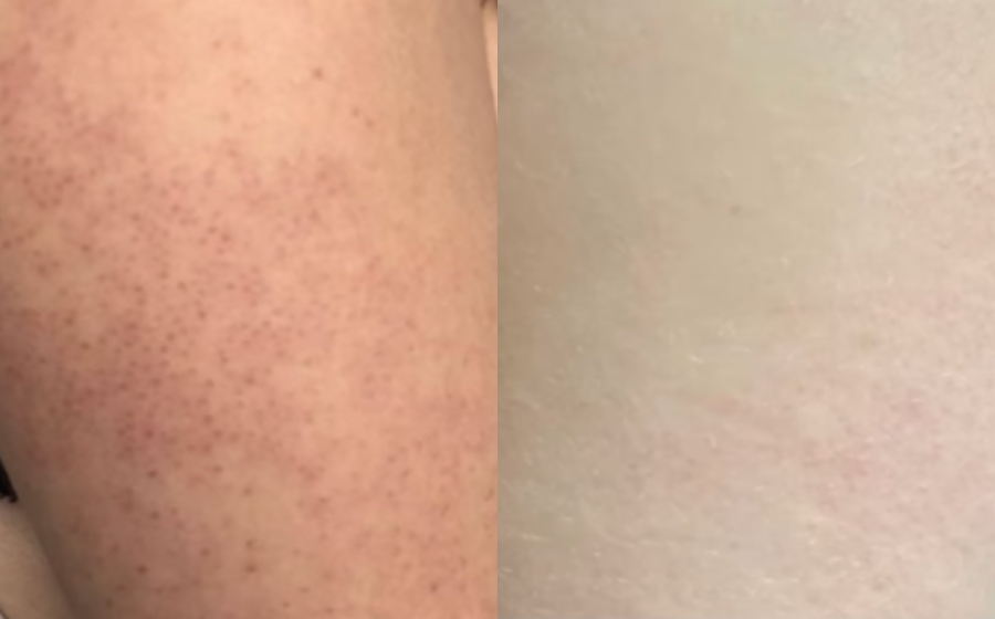 Untreated vs. after 7 days
