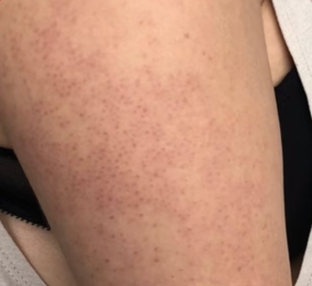 Keratosis pilaris on upper arm