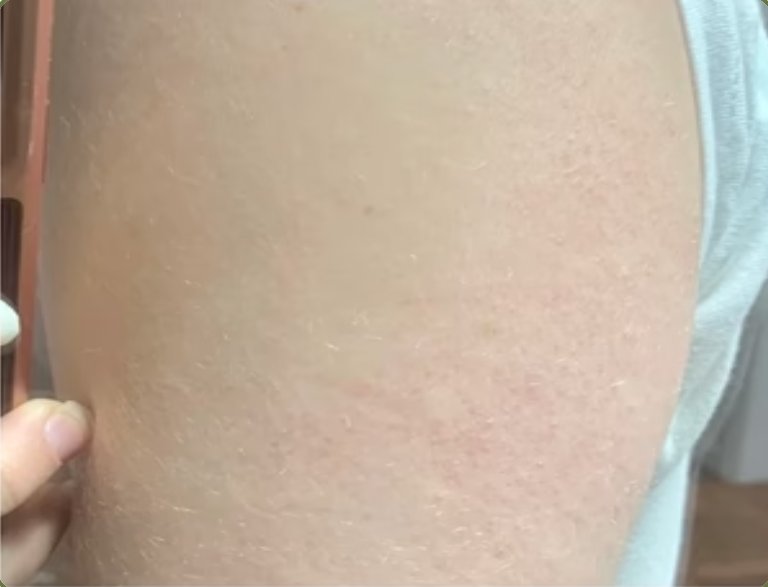 Smooth skin after treatment